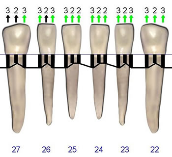 Post treatment with Perio Protect trays.