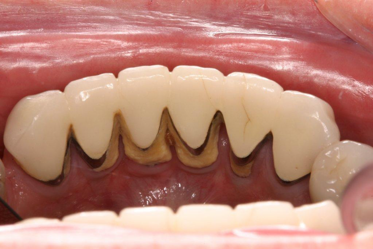 Pre-treatment for gum disease