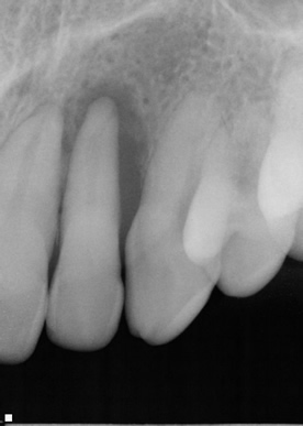 Gum-Disease-Treatment-2010-06