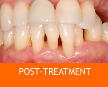 Post treatment with Perio Protect trays and gum disease is under control.