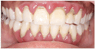 Periodontal disease in a patient of Dr. Olga Kovalenko.