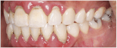 After treatment for periodontal disease.