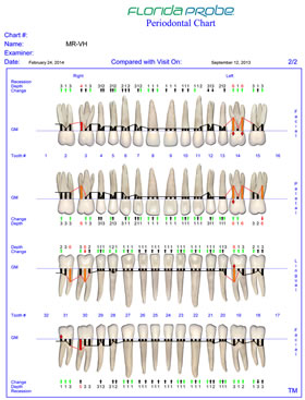 After treatment Florida Probe Periodontal Chart.