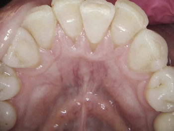 Post-treatment after using Perio Protect trays for 2 weeks, lower anterior.