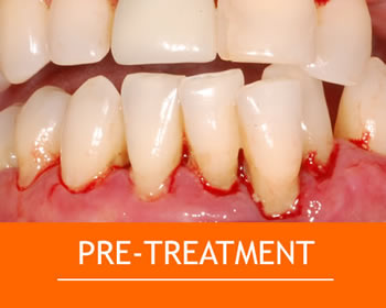 Pretreatment gum disease.