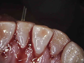 Pre-Tx-lower-anterior-sm