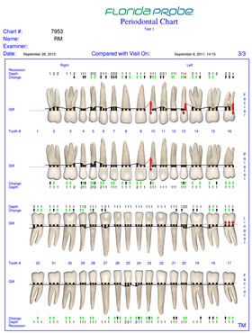 Florida Probe Periodontal Chart showing results after two seeks of treatment with Perio Protect trays.