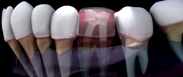 Endodontia: o tão conhecido tratamento de canal