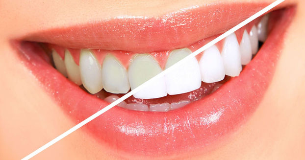 Clareamento dental com ótimo resultado no Morumbi!