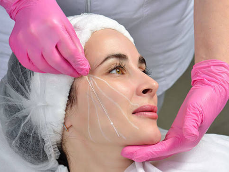 What Is a Thread Lift and How Is It Performed?