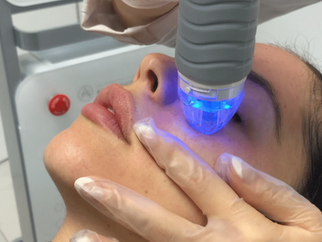 Is Fractional RF Microneedling Effective?