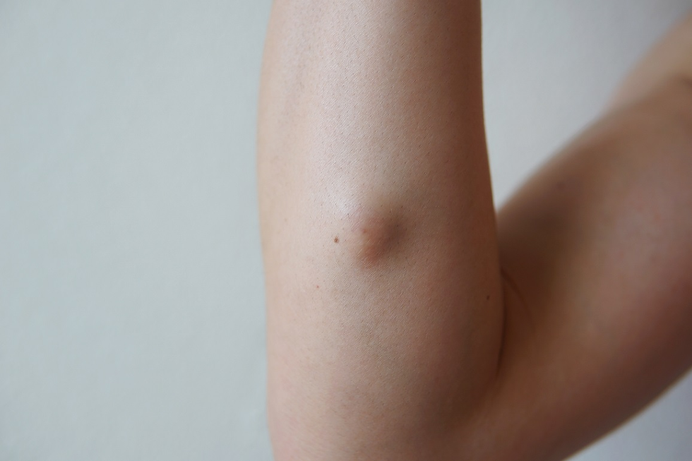 Lipoma Treatment:  You Can Try Now