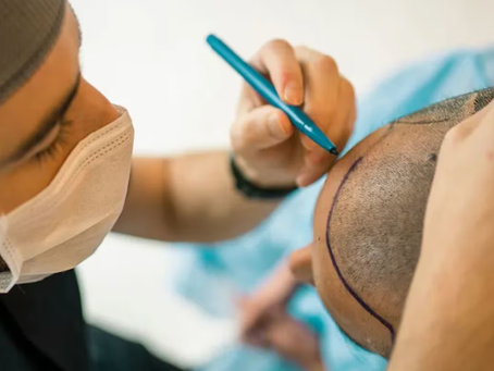 What Is the Process of a Body Hair Transplant?
