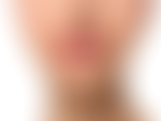 Does Russian Lip Fillersa Alter Lip Balance