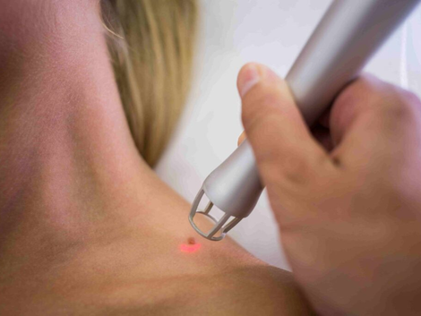 Does Warts Removal Require a Medical Procedure?
