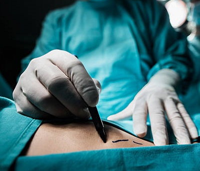How Does Laser Liposuction Work on Fat Cells?