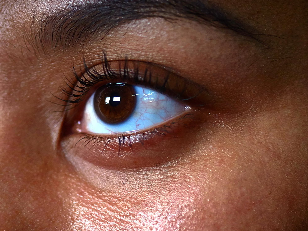 What Dark Circles Treatment Means for Skin Health