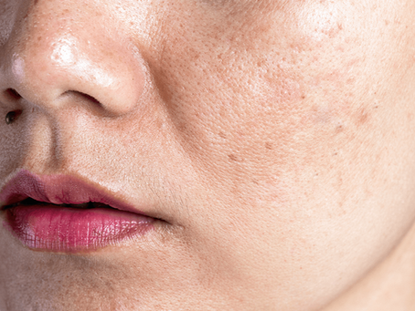 What Pigmentation Treatment Means for Skin?
