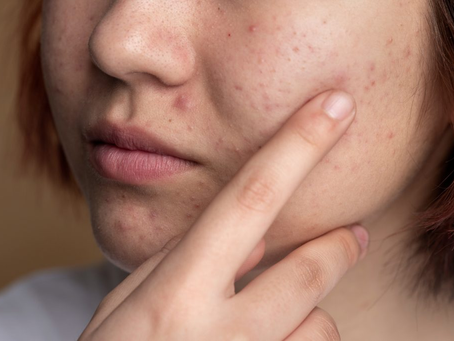 Is the Best Acne Scar Treatment Right for Every Skin Type?