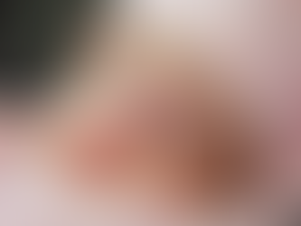 What Birthmarks Removal Treatment Means?