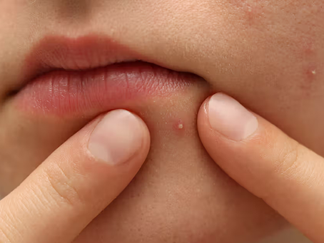 How Pimples Treatment Targets Root Causes?