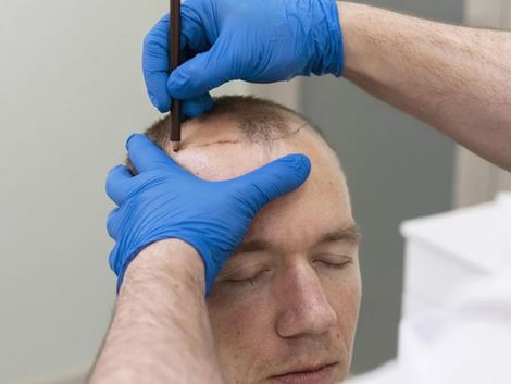 How to Prepare for the Best Hair Transplant Procedure?