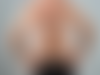 What Is the Process of Body Hair Transplant?