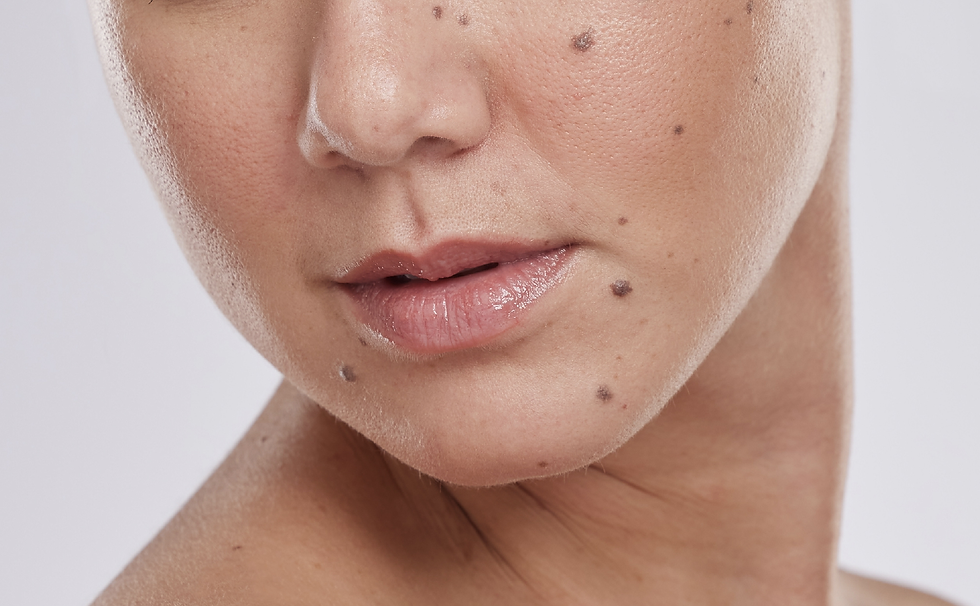 Does Mole Removal Cause Scarring?