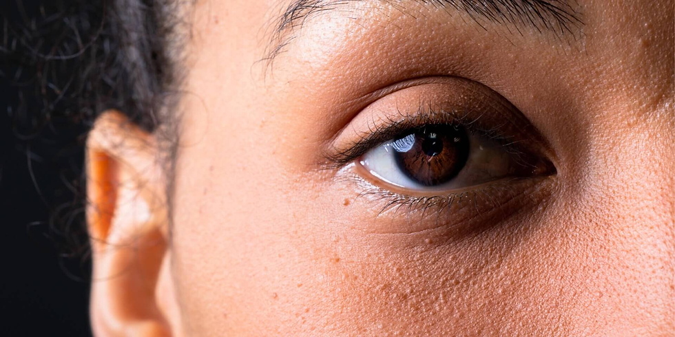 Does Dark Circles Treatment Support Eye Area Care