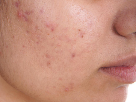What Are the Most Effective Acne Treatment Methods?