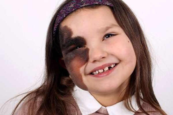 Vascular vs. Pigmented Birthmarks: Removal Differences