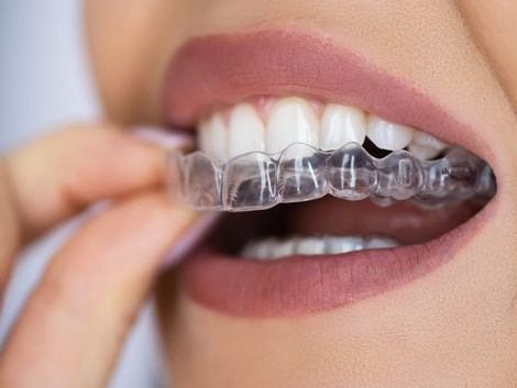 What Gum Health Means for Best Clear Aligners?