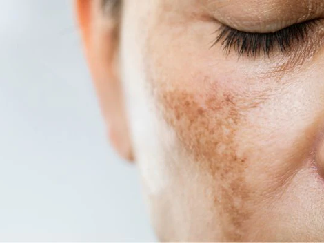 Is Pigmentation Treatment Safe For Sensitive Skin?