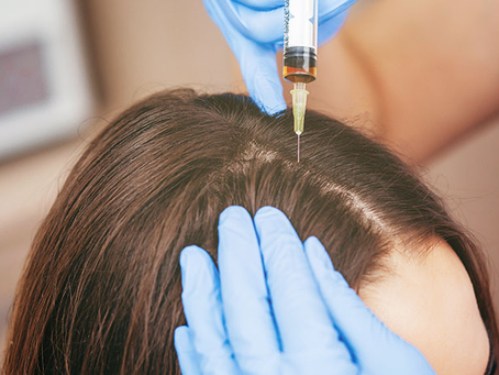 Discover the Benefits of PRP Treatments for Hair