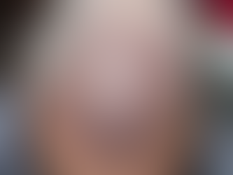 What Is a Hair Transplant Procedure?