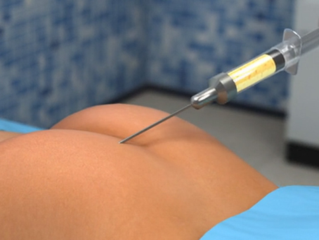 What Conditions Can Fat Injections Address?