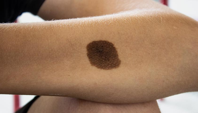 What Are the Common Birthmark Removal Methods?