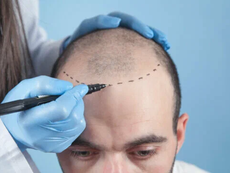 What Makes the Best Hair Transplant Effective?