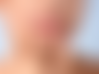 What Russian Lip Fillersa Mean in Aesthetics