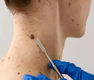 What Makes Warts Difficult to Remove?