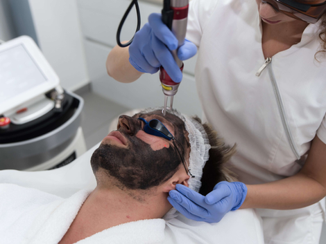 What Happens During Laser Carbon Peel?