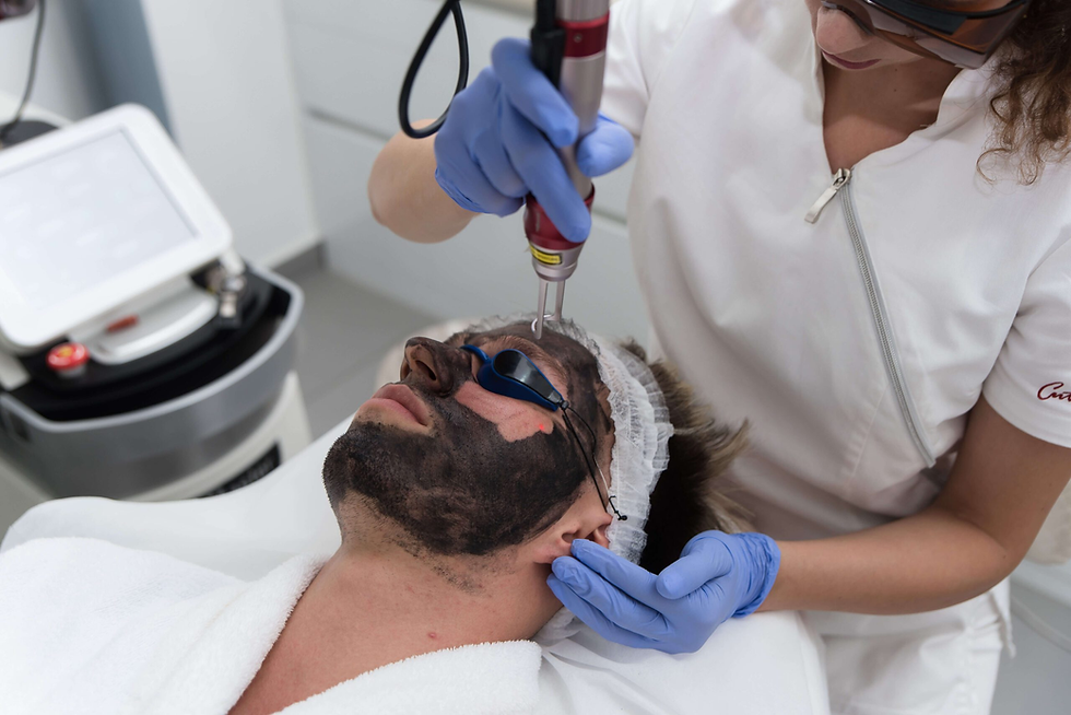 What Happens During Laser Carbon Peel?