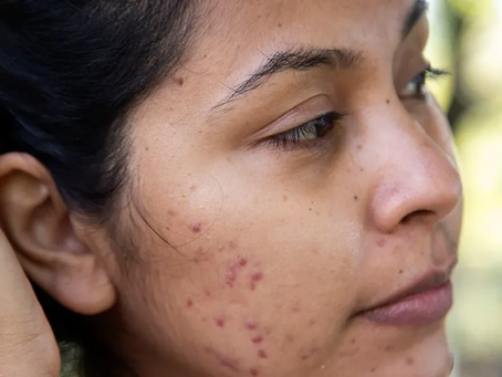 How Can Acne Scar Treatment Improve Skin Texture?