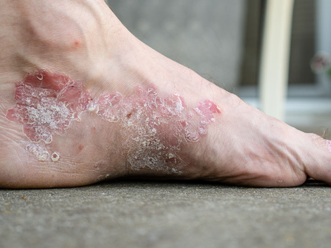 Does Eczema Treatment Focus on Causes or Symptoms?