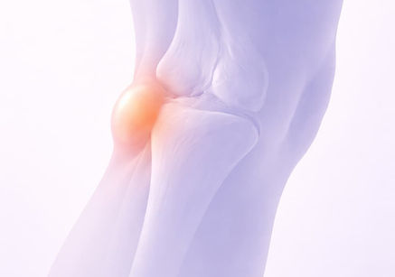 Book a PT evaluation to identify what's driving the cyst and build a plan to reduce swelling and restore knee function.