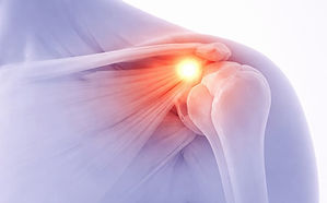 Illustration of rotator cuff tear and tendinitis showing pain at the outer shoulder and upper arm for shoulder physical therapy in Eugene, Oregon