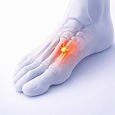 Illustration of Morton’s neuroma showing forefoot nerve pain and irritation between the toes for foot physical therapy in Eugene, Oregon at Zenith Performance and Wellness