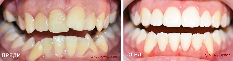 Преди и след брекети д-р. Хунджев ортодонт