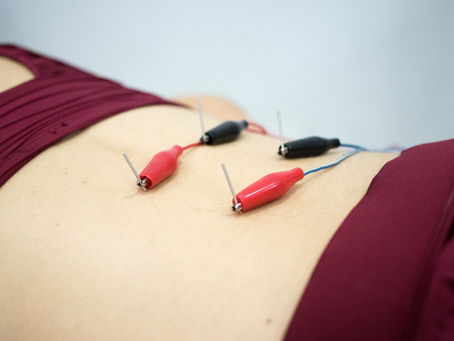 What is Dry Needling?