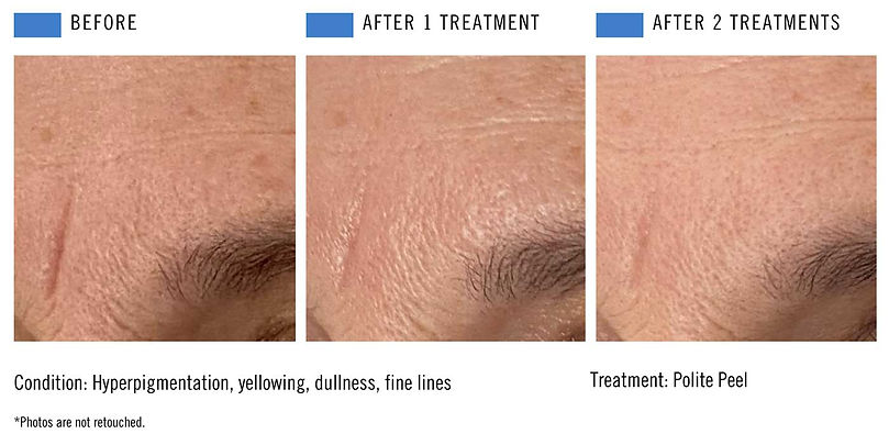 Polite Peel - Forehead -2-treatments.jpg
